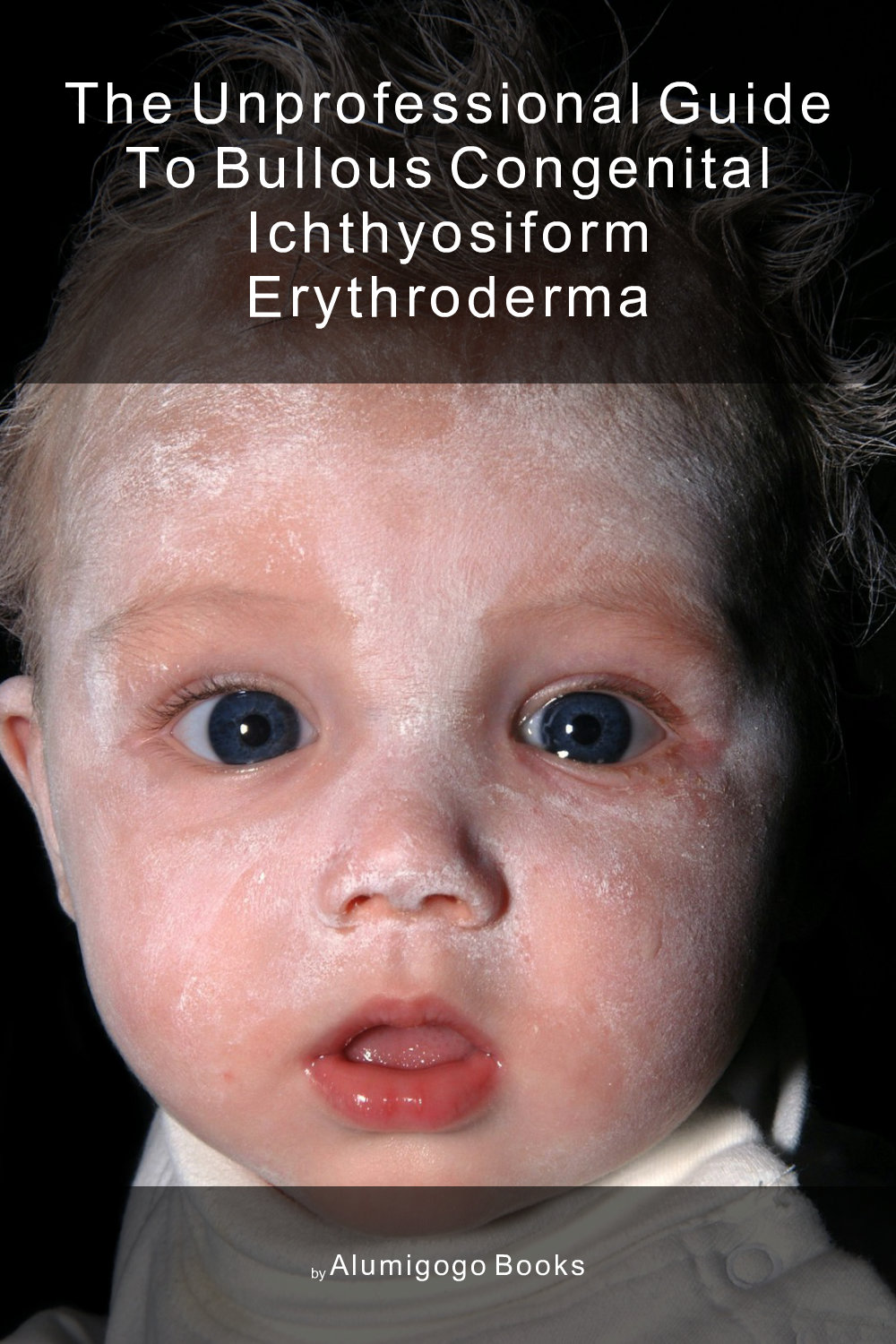 Cover of The Unprofessional Guide to bullous congenital ichthyosiform erythroderma