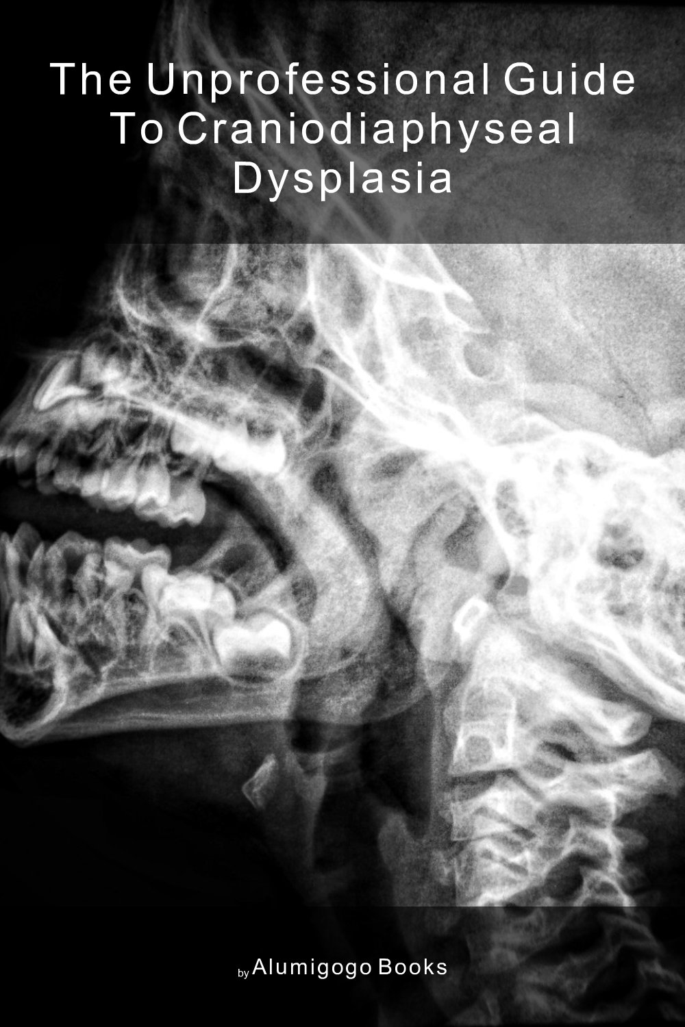 Cover of The Unprofessional Guide to craniodiaphyseal dysplasia