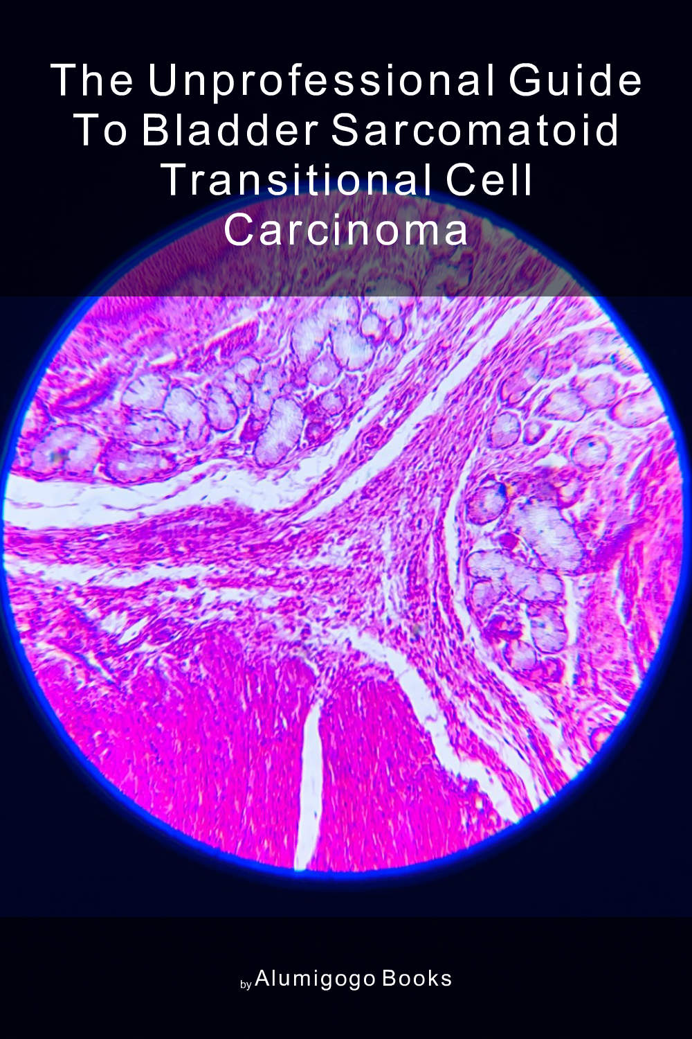 Cover of The Unprofessional Guide to bladder sarcomatoid transitional cell carcinoma