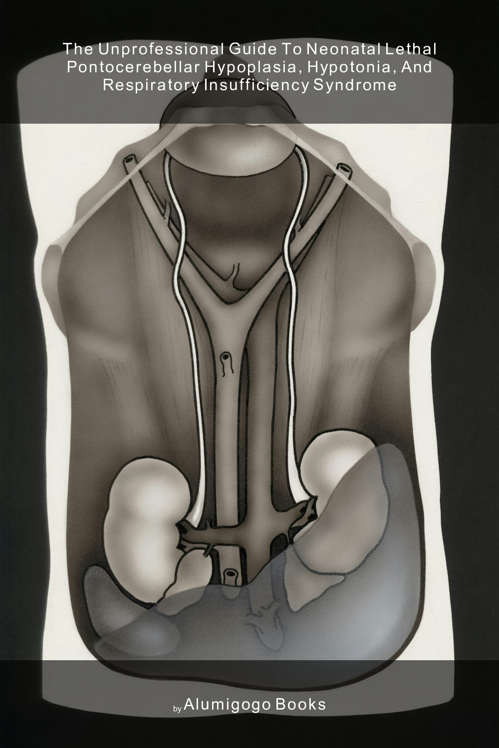Cover of The Unprofessional Guide to neonatal lethal pontocerebellar hypoplasia, hypotonia, and respiratory insufficiency syndrome